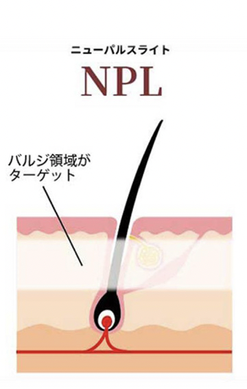 NPL
