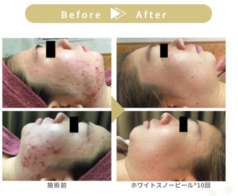 高濃度セラム＆特許美白成分でくすみゼロ！！