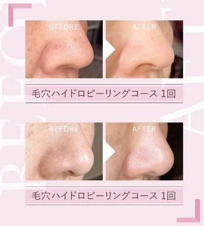 前処理として肌タイプで使い分けが出来るピールローション